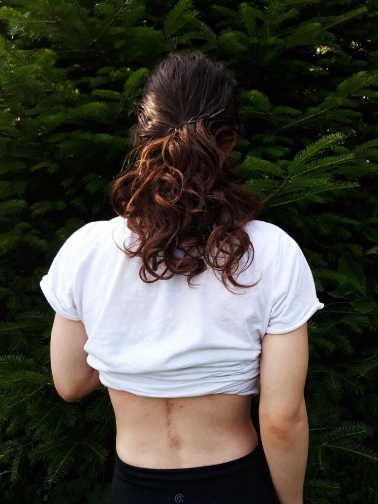 A young woman who had SDR. Her back is to the camera, and she has a scar on her lower back from SDR.
